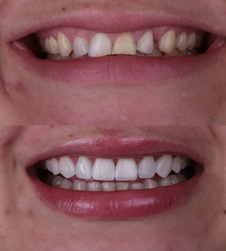 Antes e depois — caso 3