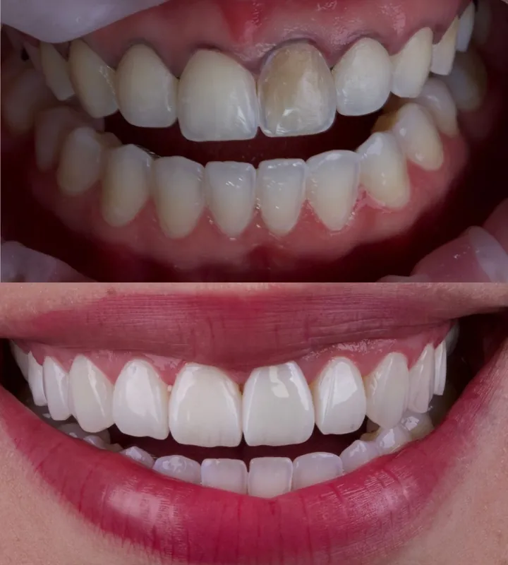 Antes e depois — caso 10