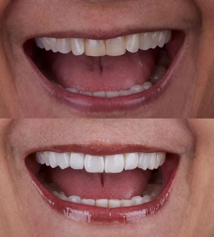 Antes e depois — caso 11